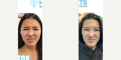 Botox before and after photo