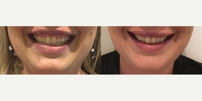 Botox for Gummy Smile before and after photo