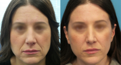 Botox before and after photo