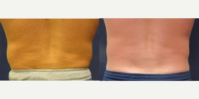 CoolSculpting before and after photo