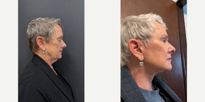 Facelift before and after photo
