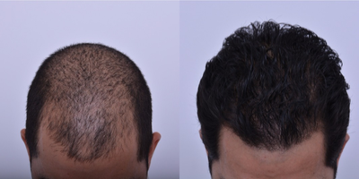 FUE Hair Transplant before and after photo