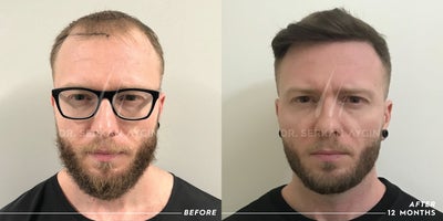Hair Transplant before and after photo