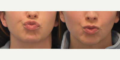 Botox before and after photo