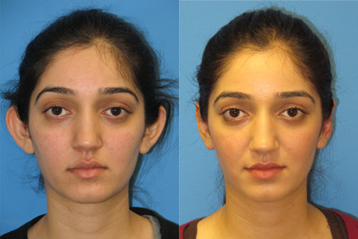 Ear Surgery before and after photo
