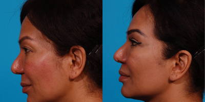 Eyelid Surgery before and after photo