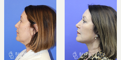 Facelift before and after photo