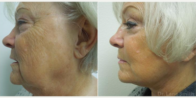 Facelift before and after photo