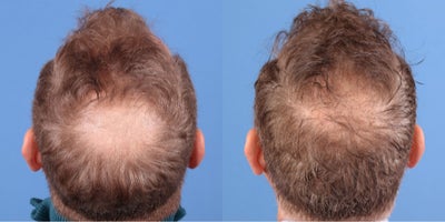NeoGraft before and after photo