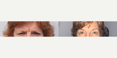 Botox before and after photo
