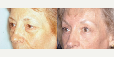 Eyelid Surgery before and after photo