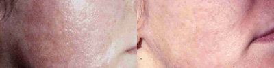Laser Resurfacing before and after photo