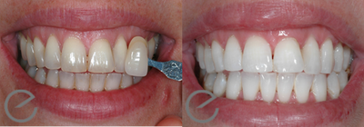 Teeth Whitening before and after photo