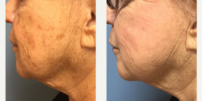 IPL before and after photo