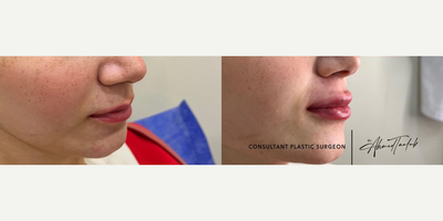 Lip Fillers before and after photo