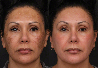 Cosmelan before and after photo
