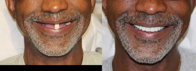 Dental Implants before and after photo