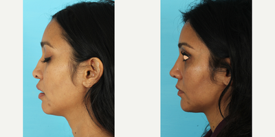 Revision Rhinoplasty before and after photo