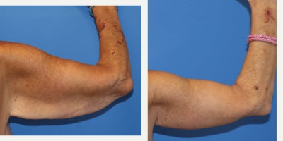 Arm Lift before and after photo