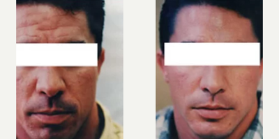 Botox before and after photo