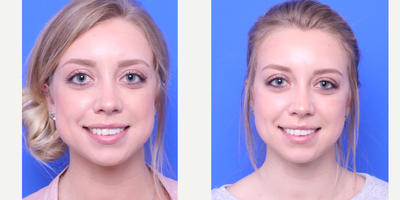 Cheek Lift before and after photo