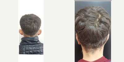 Ear Surgery before and after photo