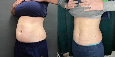 Emsculpt before and after photo
