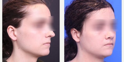Facial Feminization Surgery before and after photo