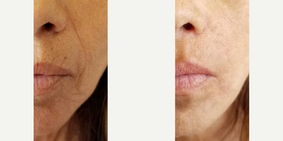 Fractional Laser before and after photo