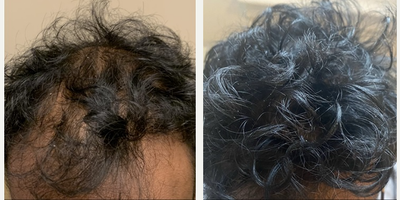 Hair Transplant before and after photo