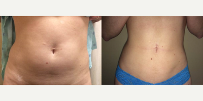 Liposuction before and after photo
