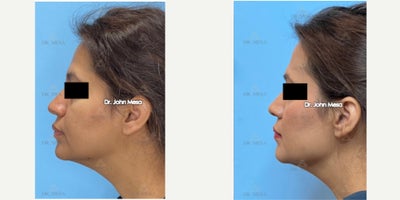 Buccal Fat Removal before and after photo