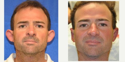 Ear Surgery before and after photo
