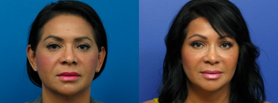 Facial Feminization Surgery before and after photo