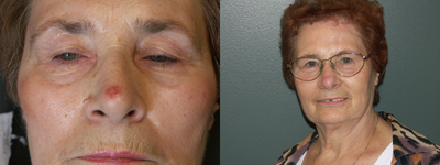 Mohs Surgery before and after photo