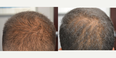 PRP for Hair Loss before and after photo
