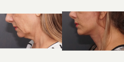 Deep Plane Facelift before and after photo