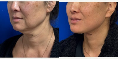 Deep Plane Facelift before and after photo