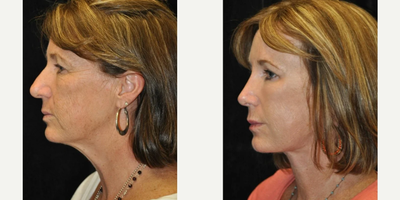 Eyelid Surgery before and after photo