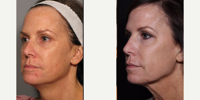 Fraxel Laser before and after photo