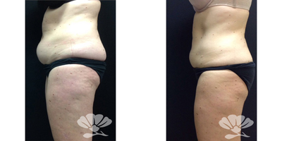 CoolSculpting before and after photo