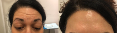 Dysport before and after photo