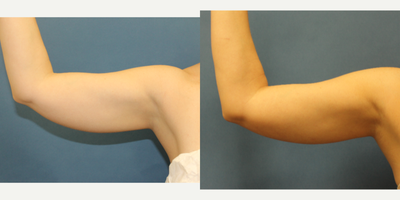 Liposuction before and after photo