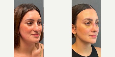 Rhinoplasty before and after photo