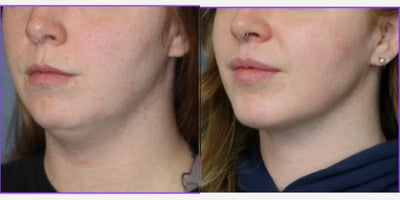 Chin Liposuction before and after photo