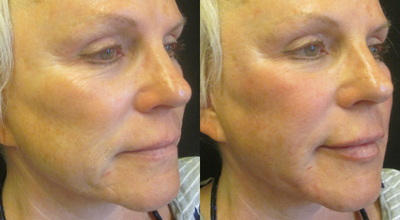 Dermal Fillers before and after photo