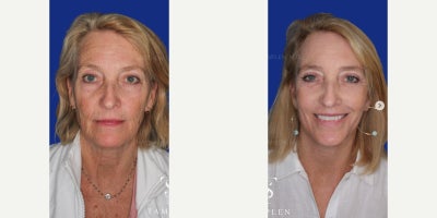 Facelift before and after photo