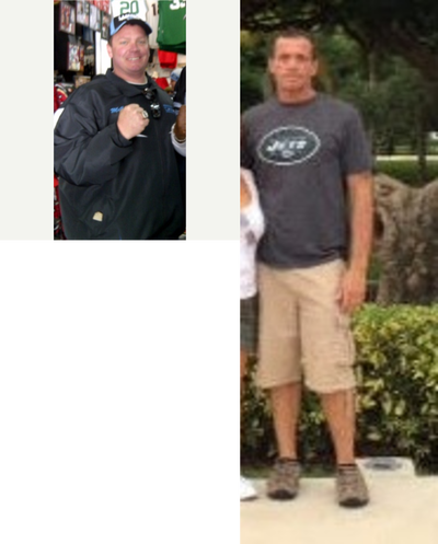 Gastric Sleeve Surgery before and after photo