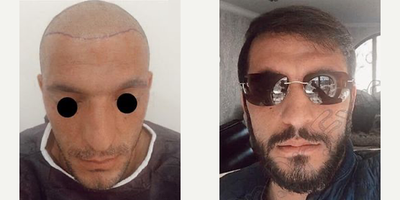 Hair Transplant before and after photo