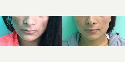 Halo Laser before and after photo